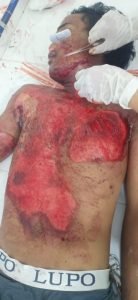 Senggol Stang Scoppy Hingga Masuk Kolong Truk, Pengendara Honda Supra Pit Tewas